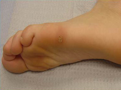Warts on left foot